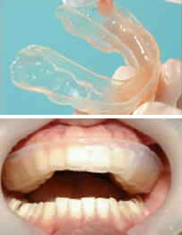 虫歯予防システムの活用
